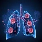 The Future of Early Lung Cancer Detection